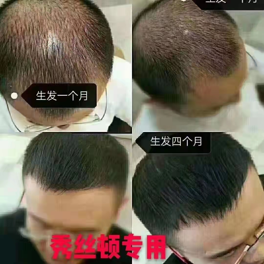 秀丝顿生发KPT疗法